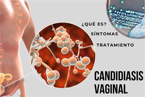 infeccin vajinal fotos reales|Candidiasis vaginal: imágenes, causas, síntomas y tratamiento